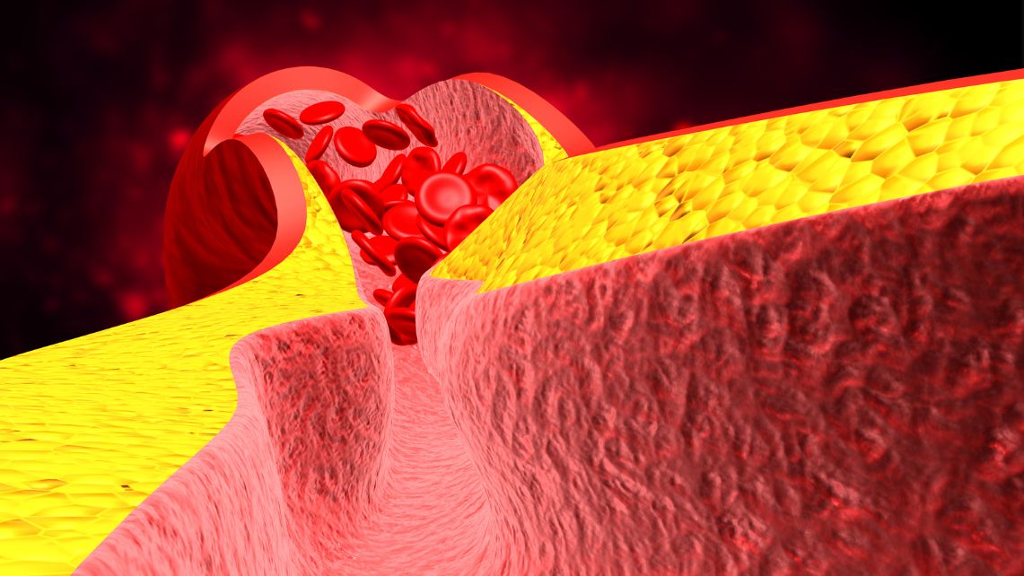 Illustration of a narrowed artery with red blood cells and a clot forming inside the vessel.